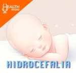 Hodrocefalia